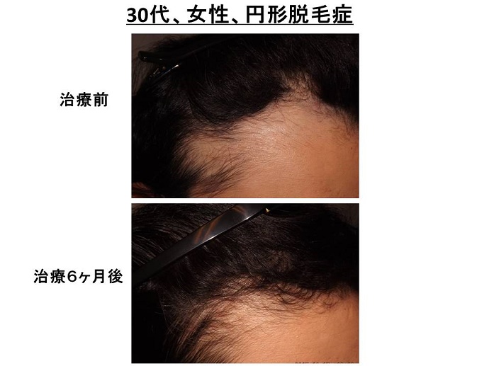 円形脱毛症　病院""